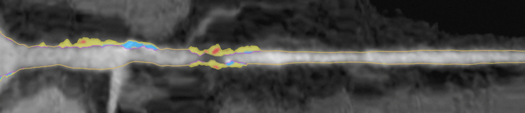 There have been several papers confirming that accumulation of plaque within the arteries is the strongest predictor of a heart attack.